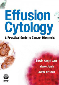 Effusion Cytology- Practical Guide to Cancer Diagnosis