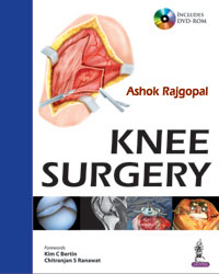 Knee Surgery