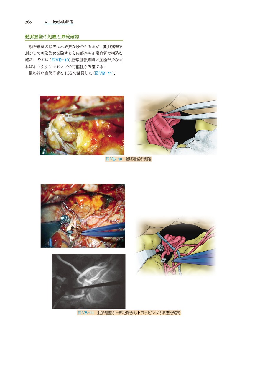 脳動脈瘤手術