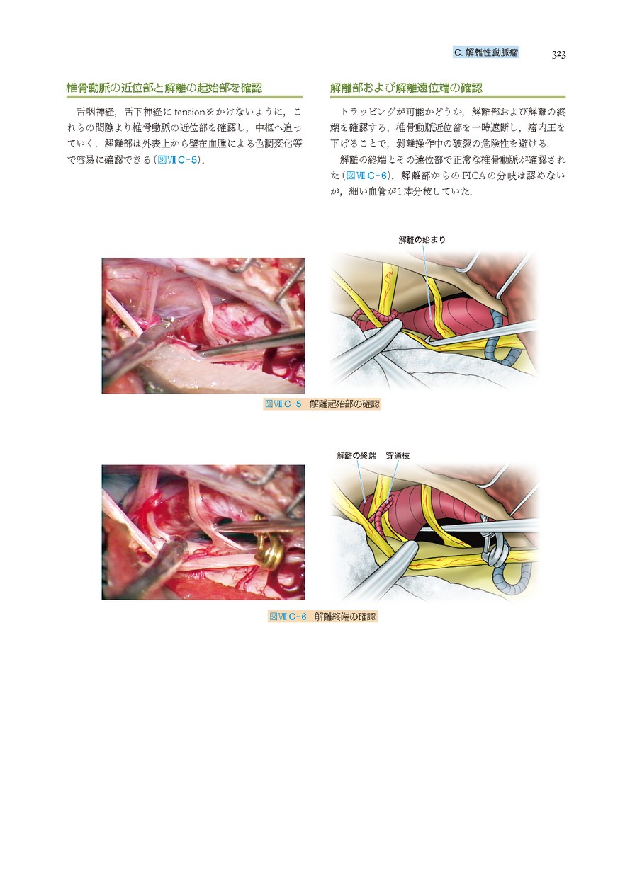 脳動脈瘤手術 | 上山博康, 宝金清博 |本 | 通販 | Amazon